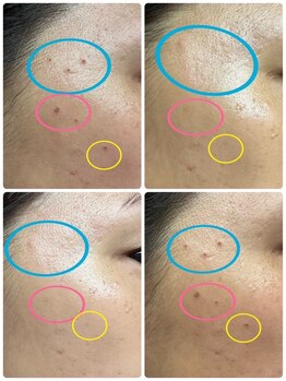 ケーエピ 長居(K-epi)/シミケア