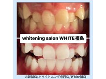 ホワイトニングサロン ホワイト(WHITE)/セルフホワイトニング/大阪/福島