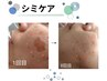 【本気のシミケア】蓄積されたメラニンを排出!あきらめていたシミを改善80分 