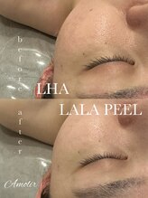 アモリール(Amolir)/ララピール　施術1回