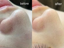 テオリア(TEORIA)/毛穴洗浄が大人気！！