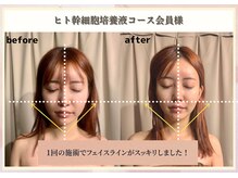 ビューティースリム リボーン 銀座店(reborn)/【ヒト幹細胞】1回の変化！