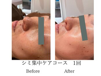 ミーシェ(Meshie)/美白パック付コース