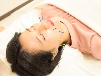 ハリ ヴァカンス(Hari Vacances)/痛みの少ない美容鍼で小顔