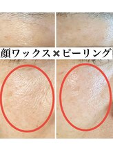 スティーン(Styin)/顔ワックス脱毛×ピーリング