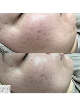 アレーズファイブフォー(A’LAISE54)/REVI ハーブピーリング