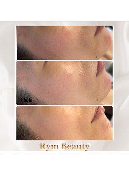 リム ビューティー(RYM BEAUTY)/ダクトピールはお顔の赤みにも♪