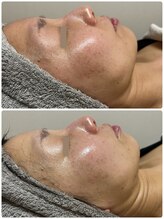 サロン アール(salon R)/プラズマミストシミケアコース