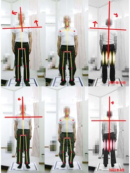 姫路なごみ整体院 なごみ鍼灸院/改善例（お尻から足の激痛