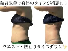 痩身革命 大宮店/気になる背中ニキビにアプローチ