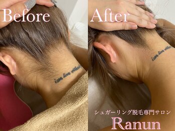 ラナン(Ranun)/タトゥー敏感肌妊婦さんも脱毛OK