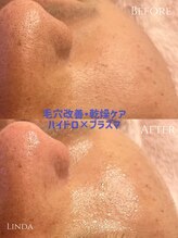 リンダ 西宮店(LINDA)/ハイドロ×プラズマ