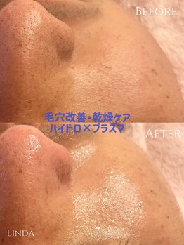 リンダ 西宮店(LINDA)/ハイドロ×プラズマ