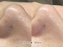 リテルナ(Re.terna)/■毛穴洗浄・毛穴ケアコース