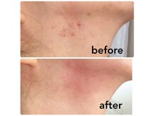 ボタニカル小顔整体(botanical小顔整体)の雰囲気(『新春ビューティーキャンペーン』首のポツポツイボ ¥3300~)