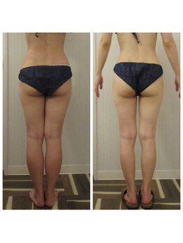 パルティール(PARTIR)/◆痩身　症例写真