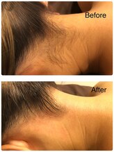 バナナ 福井店(Banana)/うなじワックス脱毛