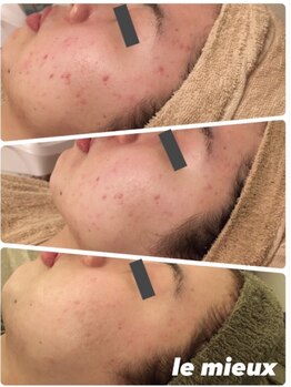 ル ミュー(le mieux)/REVI陶肌トリートメント