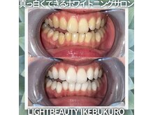 ライトビューティー 池袋店(LightBeauty)/症例写真