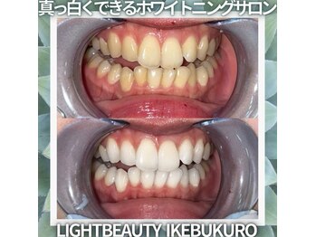 ライトビューティー 池袋店(LightBeauty)/症例写真