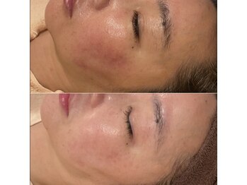 トータルエステティック ジョワイユ(JOYEUX)/肌質改善！念願の美白肌へ