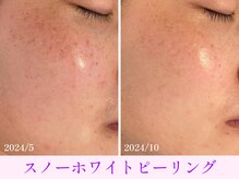 オーシャンブルー 大分店(OCEAN BLUE)/スノーホワイトピーリング