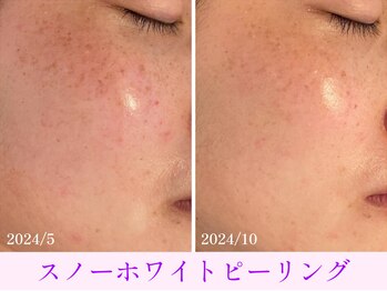 オーシャンブルー 大分店(OCEAN BLUE)/スノーホワイトピーリング