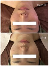 ラヴィアン(Ravian)/光フェイシャル施術後のお客様♪