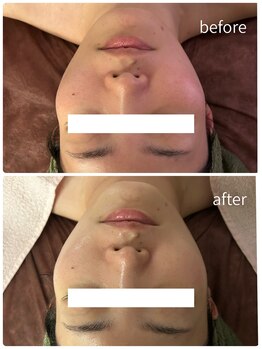 ラヴィアン(Ravian)/光フェイシャル施術後のお客様♪