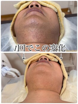 ティアレ 緑井店(Tiare)/ひげ 髭 脱毛