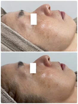 ソフィア わさだ店/60代セルマン肌質改善15回