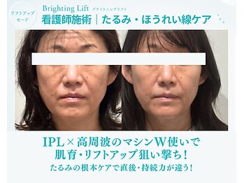ドアディ(Doordie)の写真/NEW!!【IPLリフト×高周波BTX】たるみ・ほうれい線が気になる!Wマシン使いで、肌育成×小顔リフトアップ!