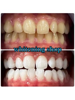 ホワイトニングショップ 三ノ宮店/【お客様のビフォーアフター】