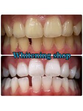 ホワイトニングショップ 福島店(WHITENINGSHOP)/学生の方も歯が命★
