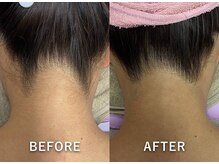 サロンドジェシカ(salon de Jessica)/うなじ脱毛　