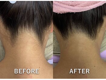 サロンドジェシカ(salon de Jessica)/うなじ脱毛　