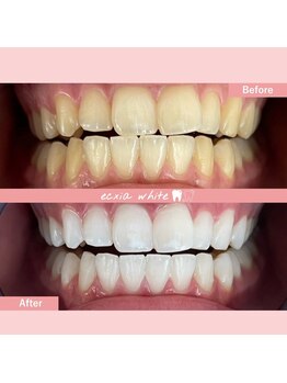 エクシアホワイトニング 札幌琴似店/ホワイトニングビフォーアフター