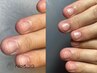 【本気で変えたいオススメ】深爪改善カラーコース