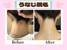 ヴィ シェーン(Vi Schoen)/うなじBefore/After 【W型】