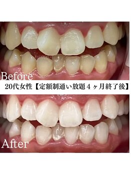 ホワイト 福岡博多店(WHITE)/ホワイトニングビフォーアフター