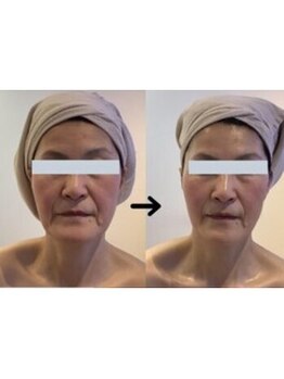 ルミナ ビューティーアンドリラックス(LUMINA Beauty&Relax)の写真/《効果を実感!二重アゴ・たるみにアプローチ!!》マスクなしでも自信が持てる上向き小顔&理想のツヤ肌へ♪
