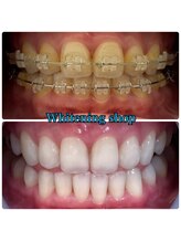 ホワイトニングショップ 三ノ宮店/お客様のビフォーアフター