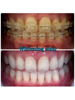 ホワイトニングショップ 三ノ宮店/お客様のビフォーアフター