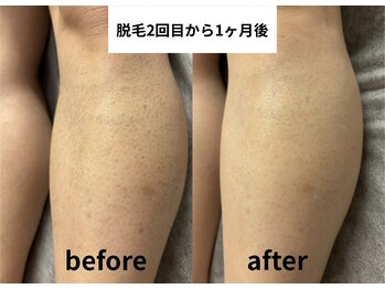 ゼロミリメートル(0mm)/【脱毛】ビフォーアフター