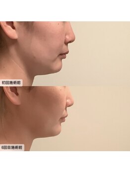 エムベル(M.belle)/リフトアップマッサージ6回