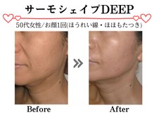 スパイア(SPIRE)/サーモシェイプDEEP★顔