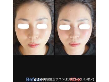 美容矯正サロン レレポノ(LELEPONO)/小顔矯正ビフォーアフター