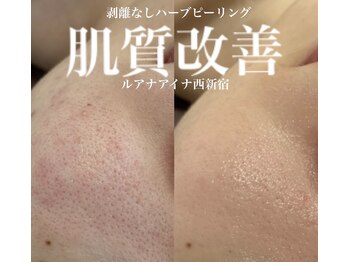 ルアナアイナ(Luana Aina)/ハーブピーリングで毛穴ケア