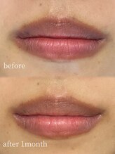 ラミパス(LAMIPAS)/ローマピンク症例　1ヶ月後