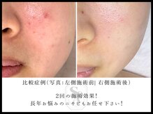 韓国肌管理室 ソア(soa)/【ニキビケアのラスボスFCR！】